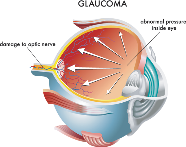 glaucoma in rahway
