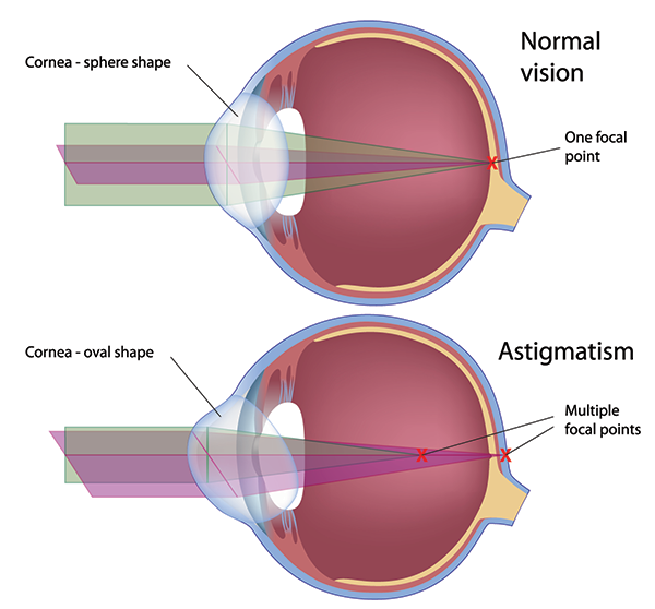 rahway astigmatism