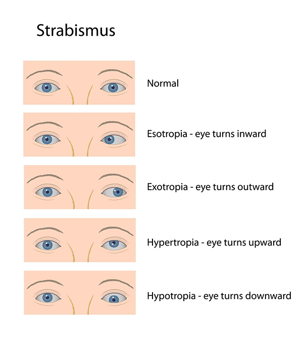 Strabismus in Rahway